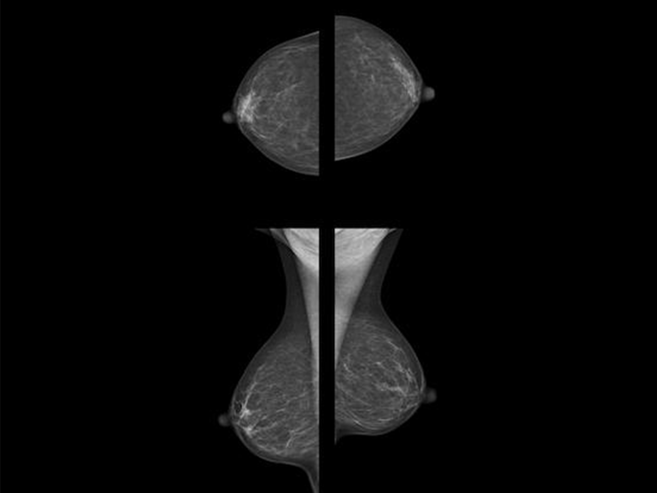 Repte cribratge càncer mama